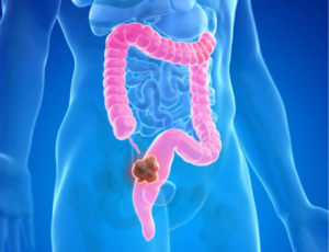 SC registra mais de 300 pacientes com câncer de intestino em 2024