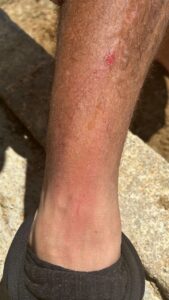 Hematoma causado após um dos chutes do agressor.