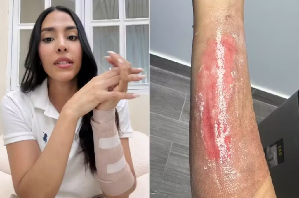 Ex-miss e modelo sofre queimaduras após panela de pressão estourar