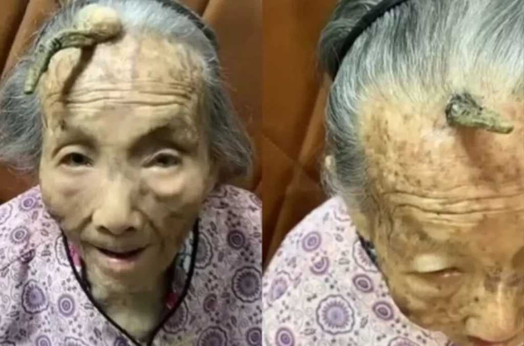 Idosa chinesa de 107 anos com chifre cutâneo de 10 cm na testa, viralizando nas redes sociais