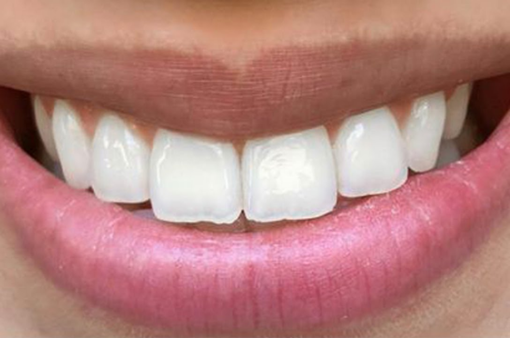 Cientistas investem em remédio para fazer dente nascer novamente
