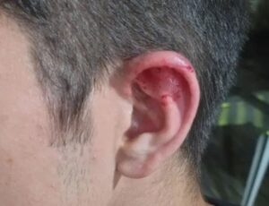 Homem morde orelha de menor e rouba celular