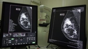 SC realiza mutirão de mamografias com prioridade
