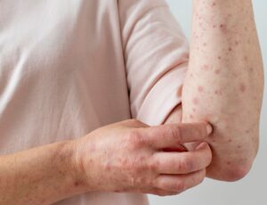 Município de SC descarta novos casos de Monkeypox