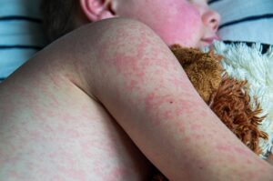 Tubarão antecipa vacinação contra o sarampo