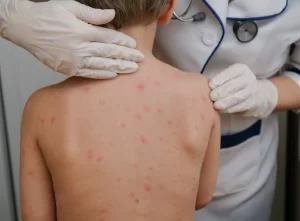 Itajaí aplicará Dose Zero contra o sarampo