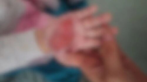 Madrasta é presa em Itapema por queimar mão de enteada de 2 anos