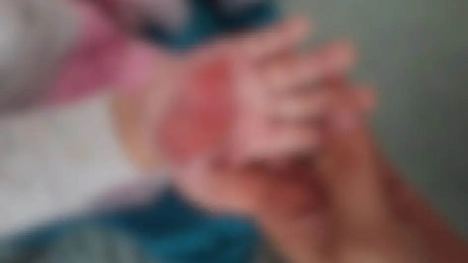 Madrasta é presa em Itapema por queimar mão de enteada de 2 anos