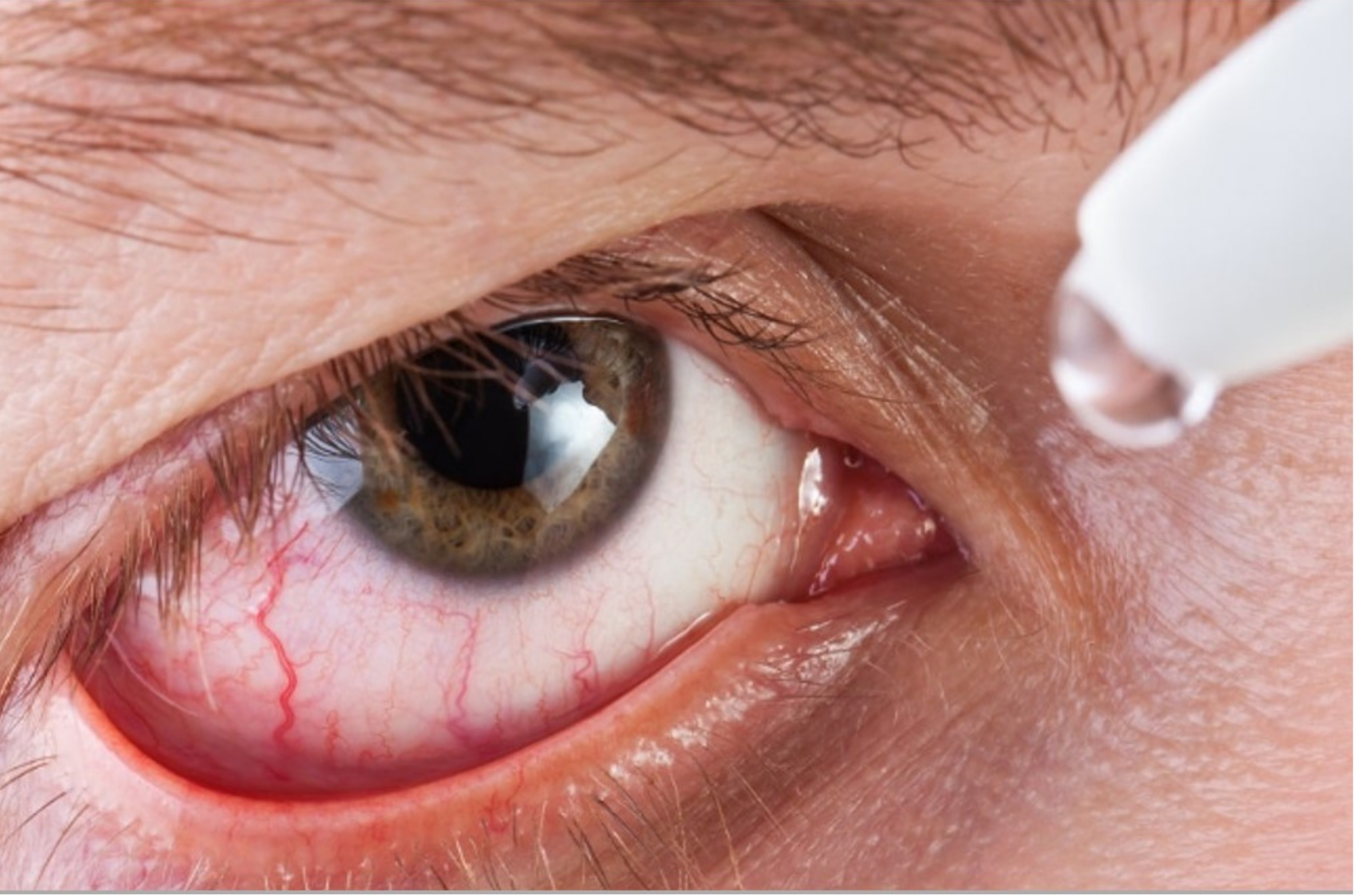 Verão e ar-condicionado elevam casos de olho seco