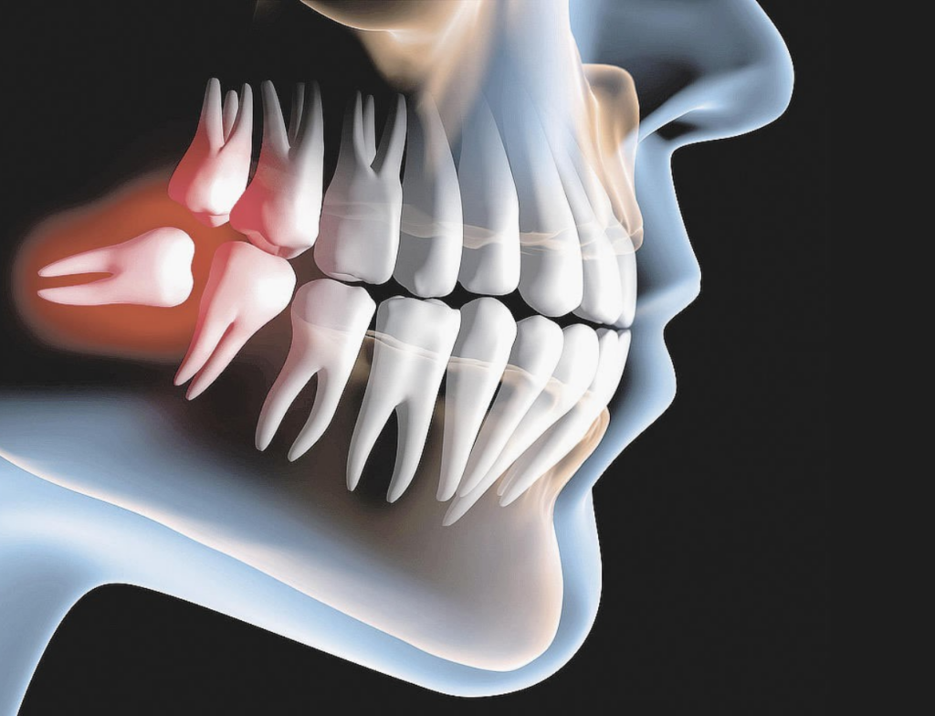 Por que o dente do siso causa dor e nem sempre precisa ser extraído