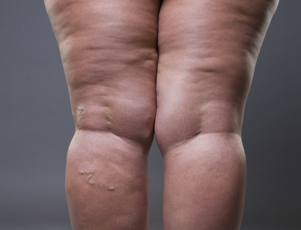 Lipedema afeta mulheres e compromete qualidade de vida, alerta médica
