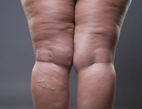Lipedema afeta mulheres e compromete qualidade de vida, alerta médica