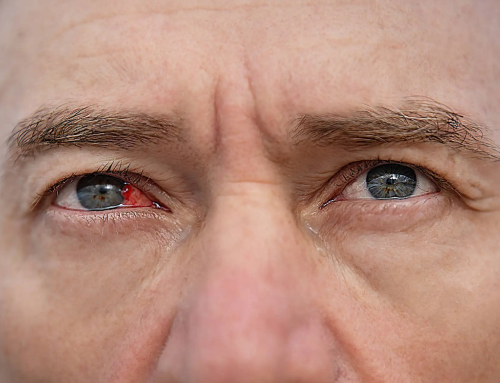 Sol forte pode causar “olho queimado”: oftalmologista alerta para riscos