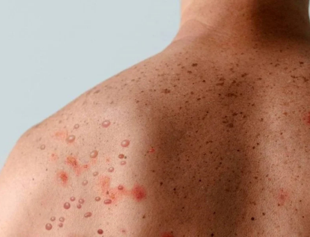 Porto Alegre confirma novo caso de Mpox em 2026