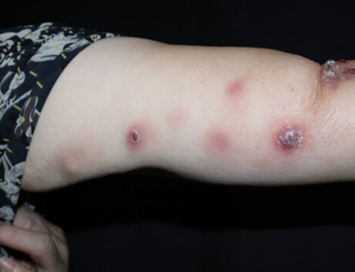 Caso humano de esporotricose é confirmado em Cocal do Sul e acende alerta