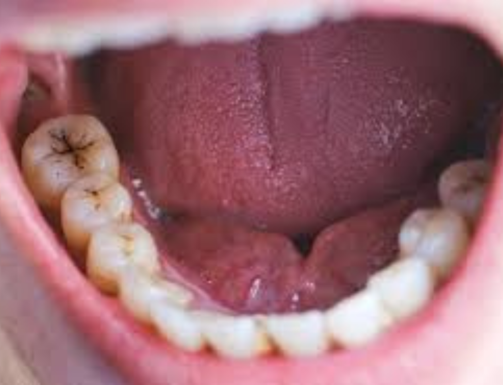 Problemas na gengiva e cáries podem aumentar risco de AVC, aponta estudo