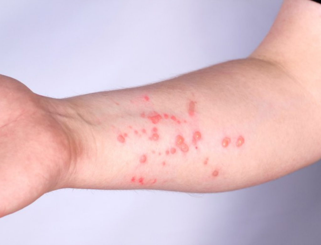 Nova cepa da mpox desafia testes e preocupa OMS