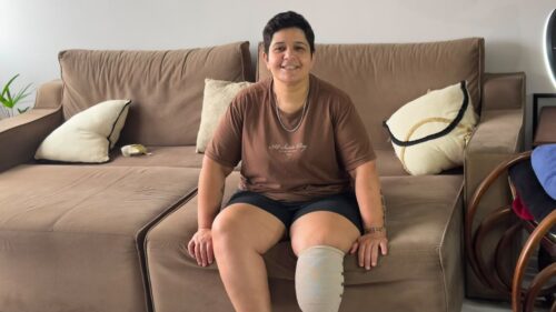 Após torção no pé, mulher perde parte da perna e faz campanha por prótese